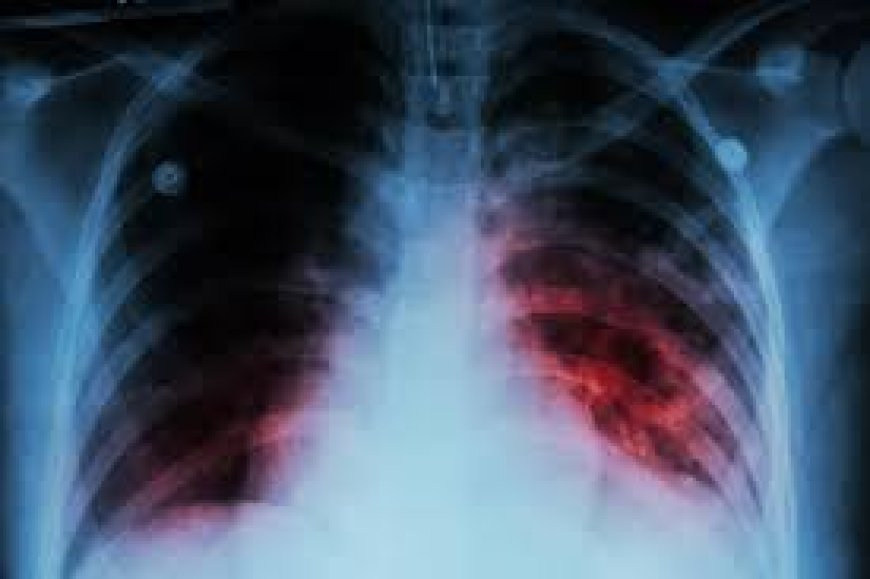 Cross River Health Commissioner Says 149 Die Of TB, 7000 Infected With Disease In Last Two Years