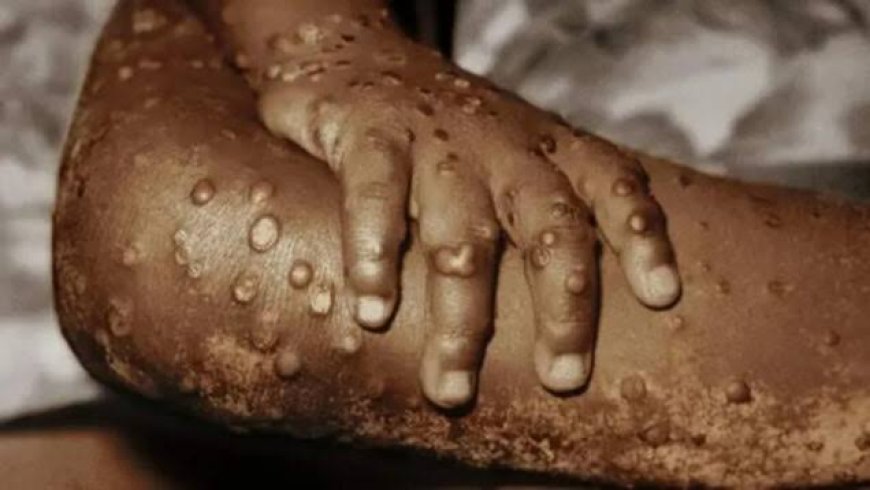 Cross River Among Top States With Mpox Cases in Nigeria, NCDC Reacts