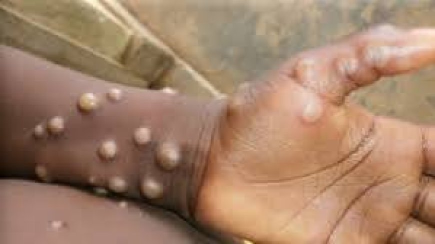 C'River confirms Mpox Case in Obudu community