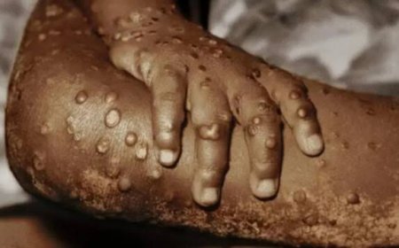 Cross River Among Top States With Mpox Cases in Nigeria, NCDC Reacts