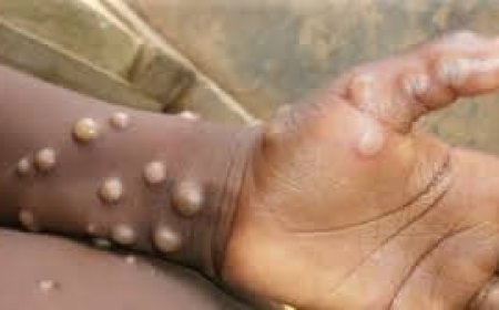 C'River confirms Mpox Case in Obudu community